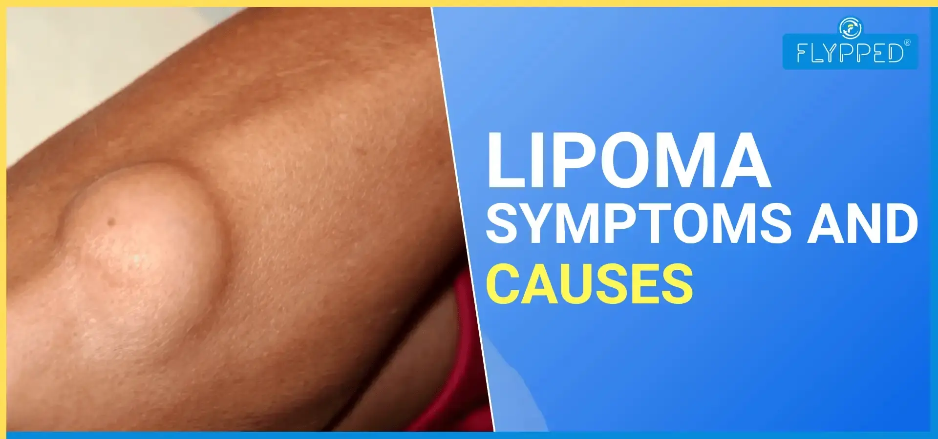 शरीर पर दिखने वाली चर्बी की गांठ: क्या यह लिपोमा (Lipoma) है?