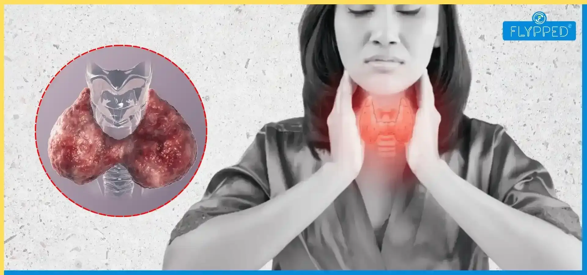 Hyperthyroidism in Hindi: लक्षण, कारण और बचाव के आसान उपाय