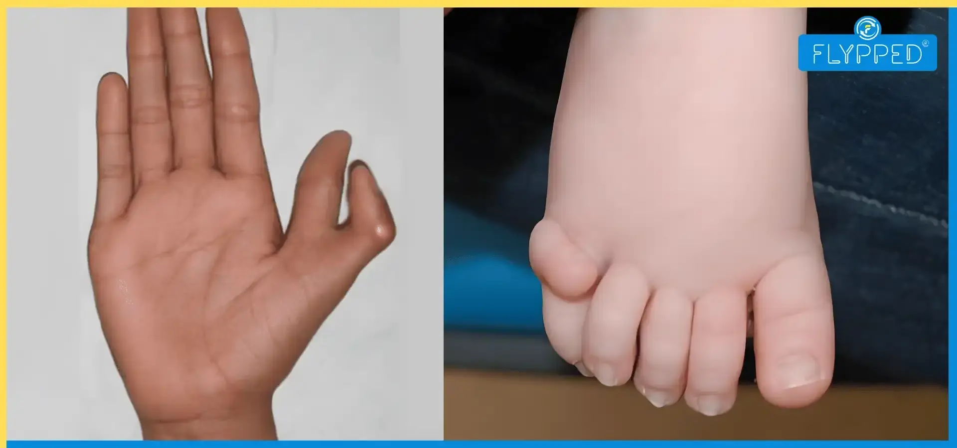 जाने हाथ या पैर में 6 उँगलियों का होना शुभ होता है या अशुभ